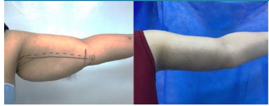 preoperative and six month postoperative photograph for patient with liposuction assisted brachioplasty.