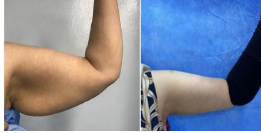 preoperative and 12 month’s postoperative photograph for patient with liposuction assisted brachioplasty.