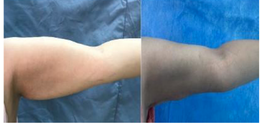 Preoperative and nine months postoperative photograph for patient with liposuction assisted brachioplasty.