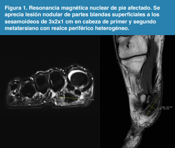 Resonancia magn�tica nuclear de pie afectado. Se aprecia lesi�n nodular de partes blandas superficiales a los sesamoideos de 3x2x1 cm en cabeza de primer y segundo metatarsiano con realce perif�rico heterog�neo.