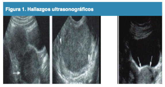 Hallazgos ultrasonogr�ficos