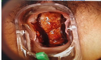 Hallazgos en la citoscopia