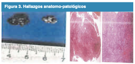 Hallazgos anatomo-patol�gicos