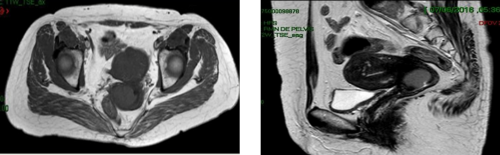 Hallazgos en la tomograf�a computada p�lvica