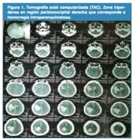 Tomograf�a axial computarizada (TAC). Zona hiperdensa en regi�n parietooccipital derecha que corresponde a hemorragia intraparenquimatosa .