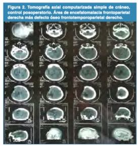 Tomograf�a axial computarizada simple de cr�neo, control posoperatorio. �rea de encefalomalacia frontoparietal derecha m�s defecto �seo frontotemporoparietal derecho.