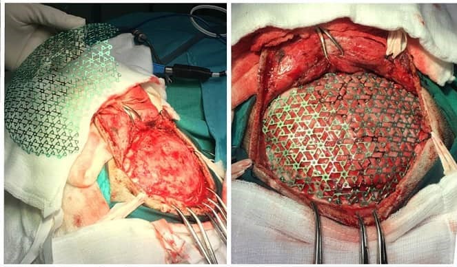 Colocaci�n malla de craneoplast�a de titanio luego de craniectom�a descompresiva.