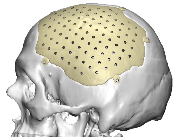 Proyecto anat�mico pre quir�rgica con pr�tesis de PEEK.