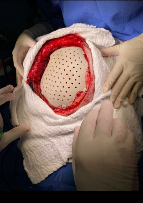 Craneoplastia con pr�tesis preformada de PEEK confeccionada con impresi�n 3D.