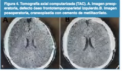 Tomograf�a axial computarizada (TAC). A. Imagen preoperatoria, defecto �seo frontotemporoparietal izquierdo.B. Imagen posoperatoria, craneoplastia con cemento de metiltacrilato.