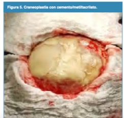 Craneoplastia con cemento/metiltacrilato.