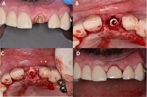 (A): un restorable central incisor (B) implant inserted in the fresh socket (C) bone graft to fill the gap around the implant (D) temporary crown inserted