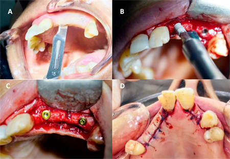 (A) flap incision using scalpel 15 (B) implant fixture insertion in native bone (C) implant in its final position and cover screw in (D) closure with nylon 5/0 interrupted sutures
