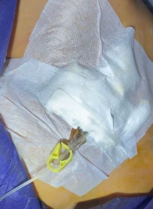 Post-Operative dressing
