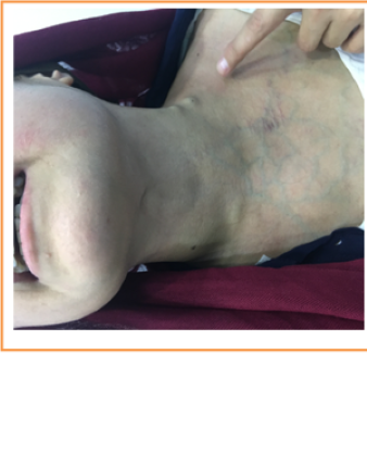 Late Thrombosis
