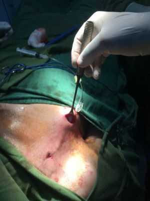dissection for pocket