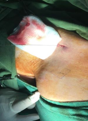 Figure 1. Seldinger Technique 