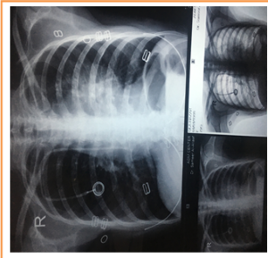 Chest XR Post-Operative