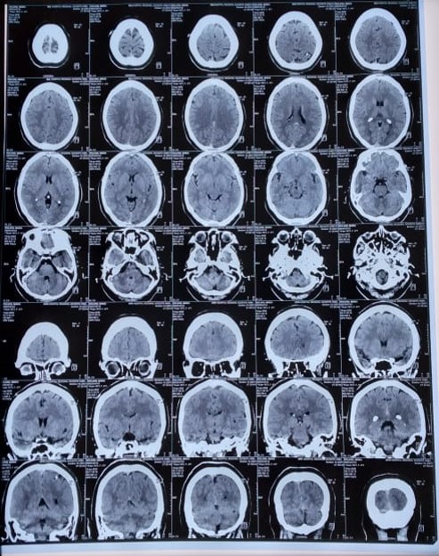 TAC simple de cr�neo. Se observa lesi�n calcificada en la regi�n parietooccipital izquierda, tambi�n se evidencia calcificaci�n de los ventr�culos coroideos. Diagn�stico de neurocisticercosis en fase de calcificaci�n nodular.