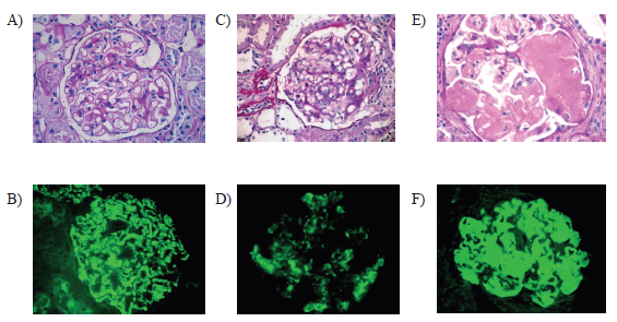 A) Membranous glomerulopathy: thickening and rigidity of capillary walls associated with marked podocytic alterations (optical microscopy, 200X); B) Membranous glomerulopathy: parietal and mesangial granular deposits of IgG (direct immunofluorescence, 200X); C) Mesangial glomerulopathy: glomerulus with matrix expansion and mesangial hypercellularity (PAS, 200X); D) Mesangial glomerulopathy: mesangial deposits of IgA (direct inmunofluorescence, 200X); E) Amyloidosis: glomerulus with mesangial deposits of amorphous, homogeneous material, weakly stained with the PAS technique (400X); F) Mesangial and parietal amyloid deposits (thioflavin T, 200X)