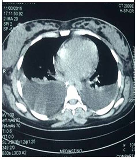 TAC de tórax con derrame pleural bilateral Fuente: Zulma Urbina, Rayza Soledad