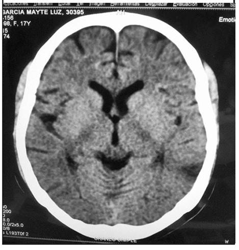TAC cerebral simple. Zona isquémica temporal izquierda Fuente: Zulma Urbina, Rayza Soledad