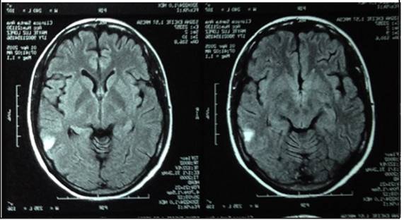 RNM cerebral. Zona isquémica temporal izquierda, muestra infarto cerebral pequeño cortical temporal posterior izq + HSA focal + discreto edema perilesional 