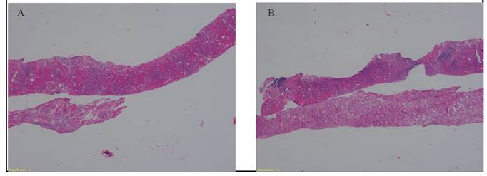 A. Imagen correspondiente a panorámica de la biopsia renal. Nótese la presencia de corteza renal con algunos grupos inflamatorios (Hematoxilina y Eosina a 4X) B. Imagen correspondiente a panorámica de la biopsia renal, otras áreas con carácterísticas similares a las vistas en A. (Hematoxilina y Eosina a 4X)