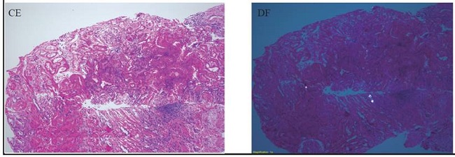 Imágenes de una porción de la biopsia sin (C, E) y con exposición a luz polarizada (D, F). Nótese la presencia de los cristales birrefringentes indicativos de la presencia de cristales de oxalatos (Hematoxilina y Eosina 10X)