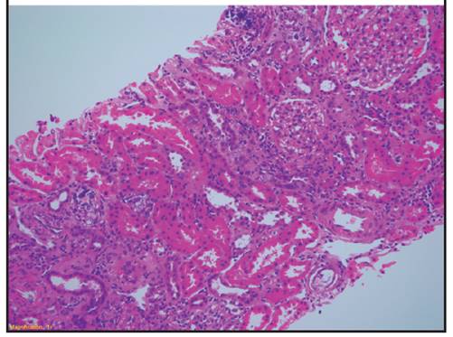 Presencia de cristales de fosfatos de calcio en las luces tubulares, evidentes como concreciones basófilas (flechas) irregulares, las cuales no polarizan al exponerlas a la luz polarizada. También se aprecian bandas de fibrosis intersticial asociadas a atrofia tubular.