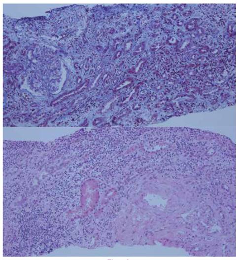 Biopsia renal de la paciente (Nefritis tubulointersticial (NTI) con componente inflamatorio agudo)