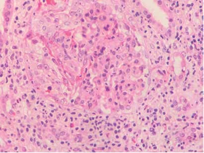Biopsia renal, tinción hematoxilina-eosina: glomérulo con medias lunas