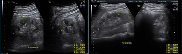 Ecografía renal: ríñones de forma, tamaño y situación habitual, incremento de la ecogenicidad, no se visualizan lesiones focales, relación cortico medular alterada. No se observa dilatación pielocalicial. El riñón derecho mide 8,2 x 4,2 x 4,1 cm, parénquima 16 mm, corteza mide 10 mm. El riñón izquierdo mide 9,3 x 3,6 x 3,5 cm, parénquima 15 mm, corteza mide 8 mm. Vejiga en escasa repleción, no se visualizan lesiones endoluminales. Liquido escaso en Morrison, volumen aproximado de 5 cc.