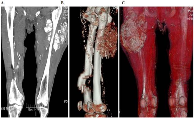 TAC simple de muslo. A. Se observa imagen compatible con densidad de calcio en muslo-izquierdo. B. Imagen lateral con reconstrucción ósea, donde se observa calcificación de arterias femorales. C. Reconstrucción de tejidos donde se observa la masa cálcica en muslo, además calcificación de arterias espermáticas.