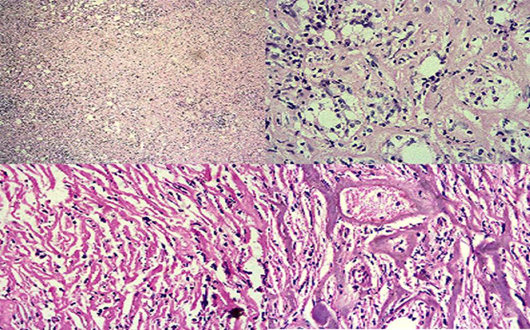 Hematoxilina/eosina. Se observan tejidos blandos con proliferación de fibroblastos y miofibroblastos reactivos con presencia de infiltrado inflamatorio linfoplasmocitario, algunos histiocitos y proliferación vascular. Hematoxilina eosina. A.4x, B-C y D. 20X.