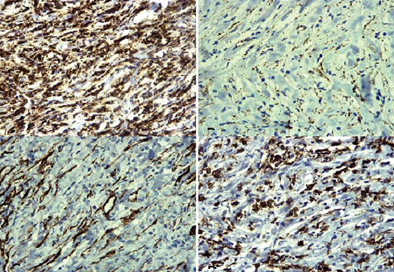 Estudios de inmunohistoquímica. A. CD 68 que resalta la población de histiocitos. B. Beta-catenina que es negativa. C. CD34 que es positivo en las paredes vasculares. D. CD45 positivo en la población de linfocitos reactivos.