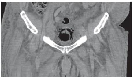 UROTAC en corte sagital anterior que evidencia vesícula disminuida de tamaño, con engrosamiento de sus paredes y gas perivesical