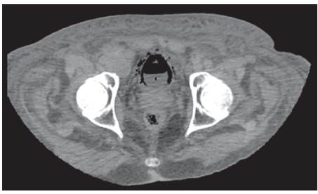 UROTAC en corte axial que evidencia engrosamiento de pared vesical y gas perivesical