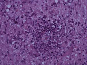Acmulos de clulas linfocticas y neutrfilos en espacios de Virchow-robin que muestran los efectos de neuroinfeccin. 