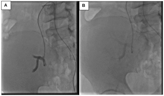 Embolizacin transcatter en caso 1