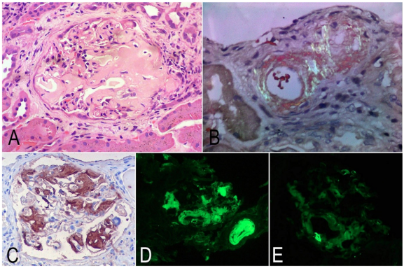 Biopsia renal. Notas aclaratorias: A: glomrulo con arquitectura distorsionada por material amorfo, acelular, eosinoflico, ocupando gran parte del mesangio y algunas paredes capilares. B: depsito amorfo en arterias, con tincin de rojo congo con luz polarizada que demuestra birrefringencia verde indicando que se trata de amiloide. C: inmunotincin para amiloide A fuertemente positivo, demostrando positividad en los depsitos glomerulares. D: inmunofluorescencia para cadenas ligeras kappa, donde se evidencia inmunotincin fuerte en los depsitos glomerulares y en una arteriola. E: inmunofluorescencia para cadenas ligeras lambda negativas (todas las imgenes con aumento original X400). 