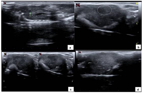  (A) Ultrasound image of liver parenchyma showing a small, homogeneous hypoechoic nodule within the liver parenchyma measuring 1.2 mm in length along the longitudinal axis (green arrow). (B) Homogeneously hypoechoic nodule (dashed oval), distinct borders measuring 4.8mm. (C) Heterogeneously hypoechoic nodule measuring 12 mm &times; 8.2 mm (green arrow). (D) Heterogeneously hyperechoic nodule occupying a large portion of the liver parenchyma (dashed oval), measuring 17.1 mm in length along the longitudinal axis (diameter 2).