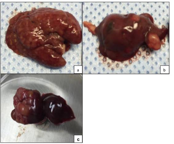 Explanted gross specimens reveal morphologically distinct hepatic lesions, indicated by tissue discoloration: (A) diffuse, (B) multifocal, and (C) solitary lesions.