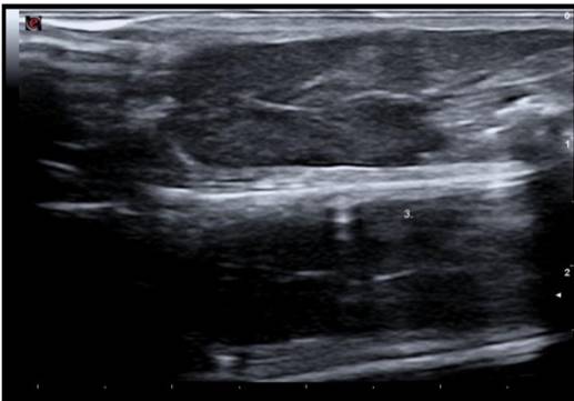 Ultrasound image of a homogeneous and normoechoic liver parenchyma.