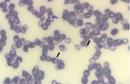 Inclus&otilde;es parasit&aacute;rias em hem&aacute;cias caracter&iacute;sticas de Babesia sp. (setas), observadas em esfrega&ccedil;o sangu&iacute;neo de bovino. Colora&ccedil;&atilde;o com pan&oacute;tico, aumento original 1000x.