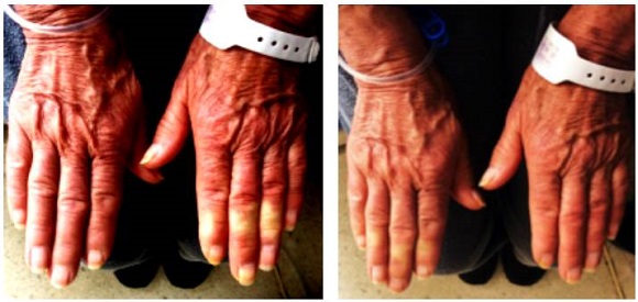 Raynaud's phenomenon.