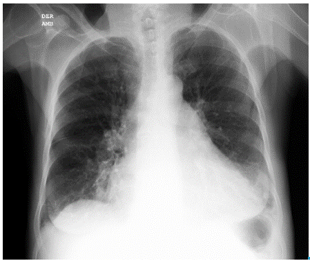 RChest radiograph. Posteroanterior view.
