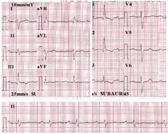 12-lead electrocardiogram. Findings include first-degree AV block and right bundle branch block.