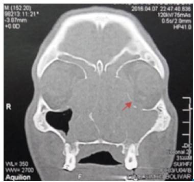 CT scan of nose and paranasal sinuses. Coronal view: complete occupation of left maxillary sinus, frontal and bilateral ethmoidal sinuses. Arrow: Eroded left lamina papyracea.