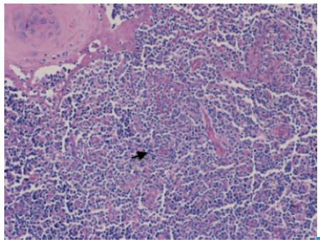 Soft palate biopsy. NK/T extranodal nasal type lymphoma. Arrow. Polymorphous lymphoid infiltrate with angiocentric distribution.